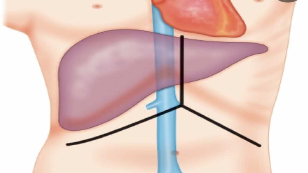 الجرح الطبي لعملية زراعة الكبد هو الخط باللون الأسود (الكبد باللون البنفسجي)
