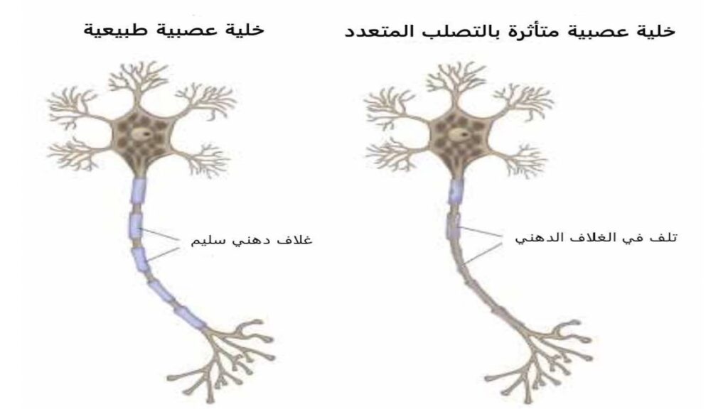 تأثير التصلب المتعدد على الخلية العصبية