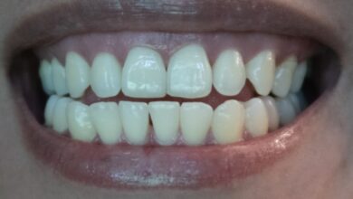 5 نصائح تحميك من التهاب الاسنان وخراج الضرس - خراج الاسنان