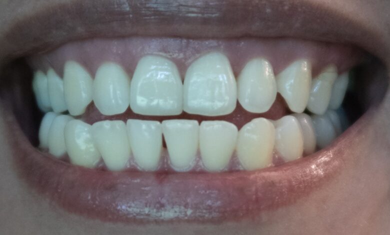 5 نصائح تحميك من التهاب الاسنان وخراج الضرس - خراج الاسنان