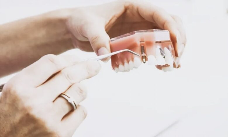 ما هي خطوات زراعة الاسنان (بالصور)؟ 5 خطوات أساسية