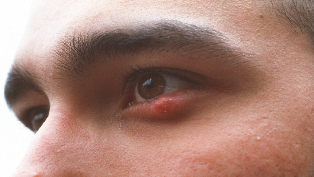 ما سبب تكرر خراج جفن العين (دمل العين)؟ وما العلاج؟