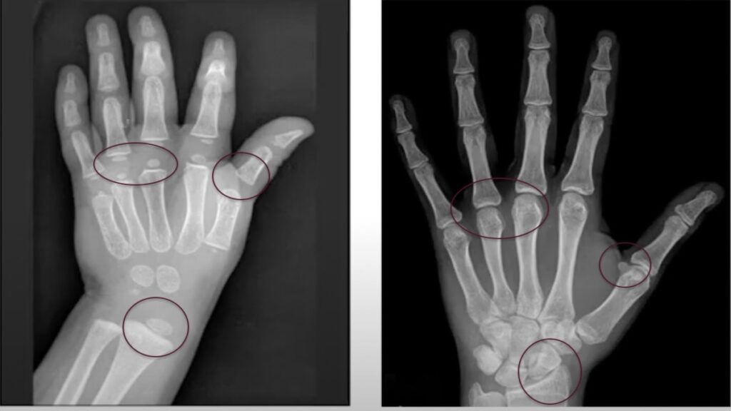 الفرق بين أشعة اليد اليسرى قبل البلوغ (علي اليسار) وبعد البلوغ (على اليمين)