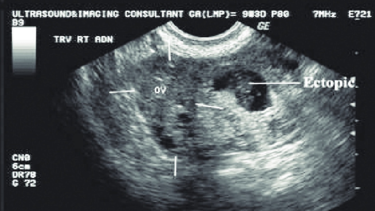 الحمل خارج الرحم ectopic pregnancy