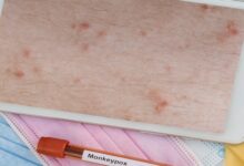 الطفح الجلدي - جدري القرود