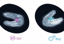 معرفة نوع الجنين ب السونار اثناء الحمل بالصور .. ولد ولا بنت؟