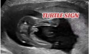 صور جنين ذكر في السونار (ولد)