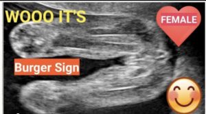 صورة جنين انثى في السونار